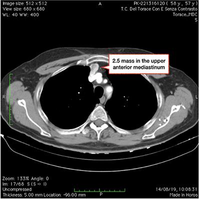 Case Report: Multidisciplinary Approach for a Rare Case of Thymic Vascular Malformation